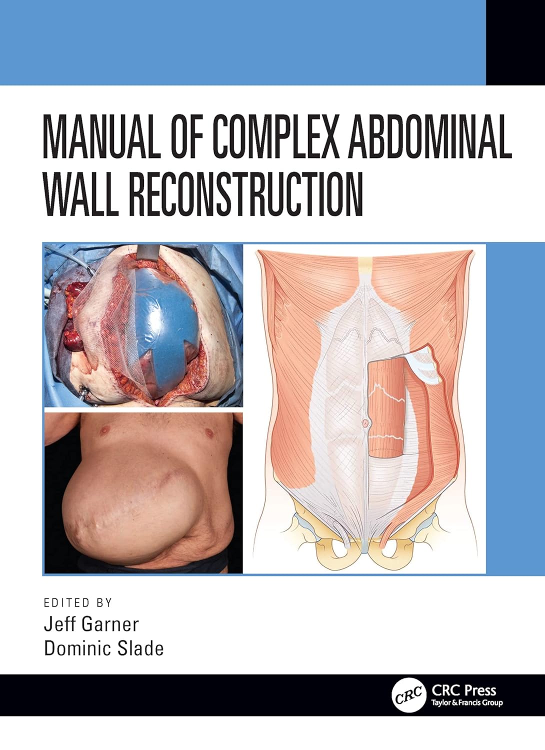 Buy Manual of Complex Abdominal Wall Reconstruction (English, Paperback, Jeff Garner, Dominic Slade) Online at Best Price - BookBajar