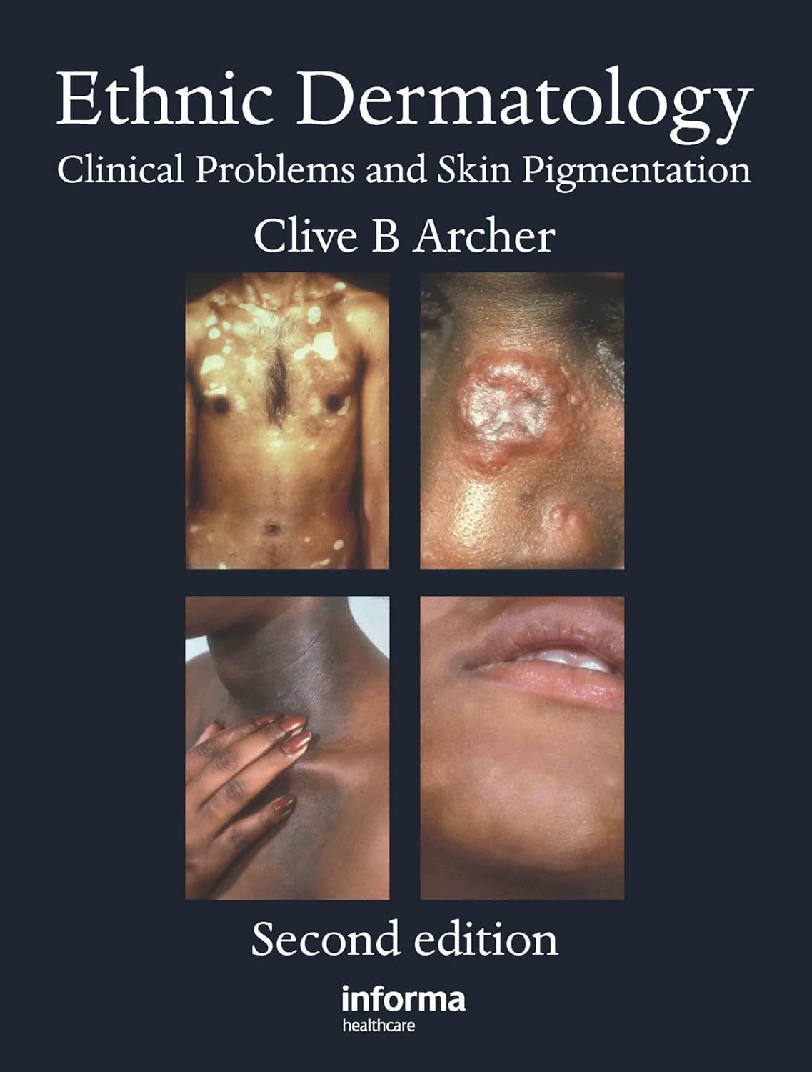 Buy Ethnic Dermatology: Clinical Problems and Skin Pigmentation (English, Paperback, Clive B. Archer) Online at Best Price - BookBajar