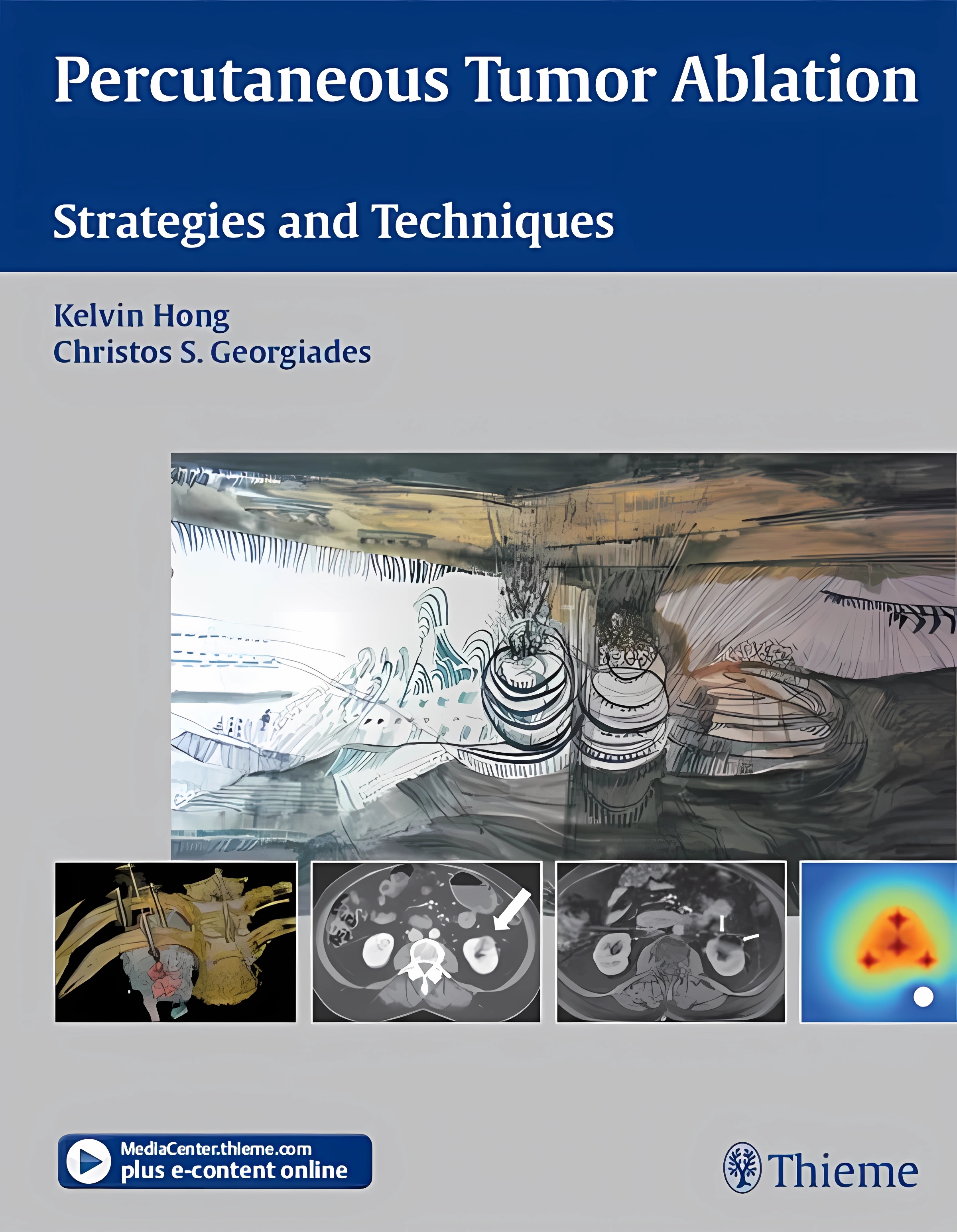 Buy Percutaneous Tumor Ablation: Strategies and Techniques (English, Paperback, Kelvin Hong) Online at Best Price - BookBajar