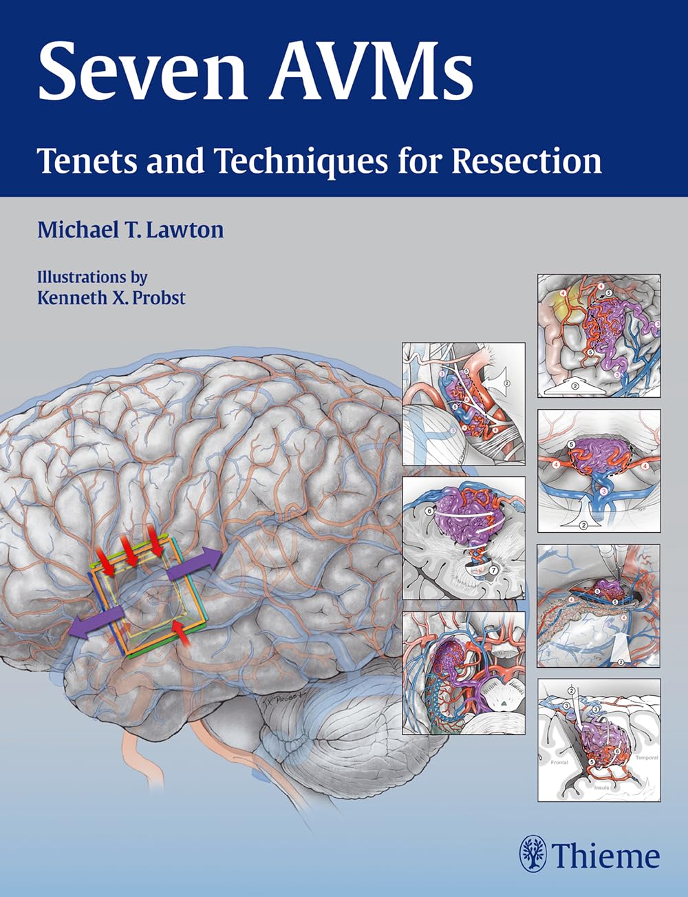 Buy Seven AVMs: Tenets and Techniques for Resection (English, Paperback, Michael T. Lawton) Online at Best Price - BookBajar