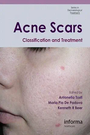 Buy Acne Scars: Classification and Treatment: 6 (Series in Dermatological Treatment) (English, Paperback, Antonella Tosti, Maria Pia De Padova, Kenneth... Online at Best Price - BookBajar